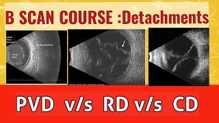 B scan course  differentiate retinal detachment from vitreous detachment and choroidal detachment [upl. by Najtsirk]