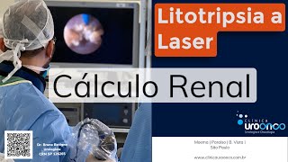 Por que fazer Litotripsia a Laser para o tratamento do cálculo Renal Pedra no Rim Entenda [upl. by Chapnick830]