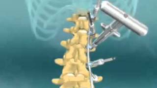 Scoliosis Spinal Fusion Animation [upl. by Ollie]