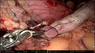 Robotic Harvesting of Pedicled Omental Flap [upl. by Lauren]