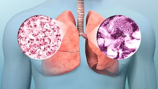 Lung Cancer Early Diagnosis Treatment [upl. by Adlez500]