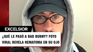 Bad Bunny aparece con el ojo morado ¿qué le pasó al reguetonero [upl. by Nanete]