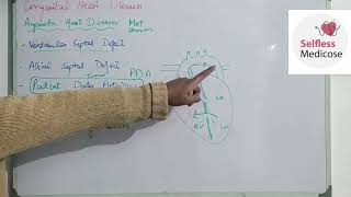 FCPS part 1CVS lecture 20 ACYANOTIC HEART DISEASES made easy [upl. by Litch]