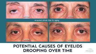 Possible Causes of Drooping Eyelids Eyelid Ptosis in Adults [upl. by Gairc939]