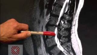 Low Back Pain Part 8 Spinal Stenosis [upl. by Arag]