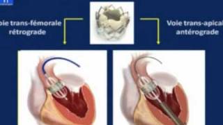 Implantation percutanee dune valve aortique [upl. by Erej]