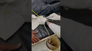 How to remove folye’s catheter  folye’s catheter [upl. by Selec30]