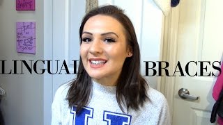 MY LINGUAL BRACES EXPERIENCE [upl. by Ayar]