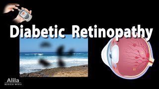 Retinopathy Diabetic and Hypertensive Animation [upl. by Wiencke]