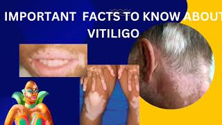 vitiligopart2diagnosis and latest treatment about opzelura creamskinhealthvitality5959 [upl. by Godspeed]