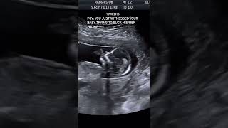 Ultrasound scan In Pregnancy [upl. by Larue]