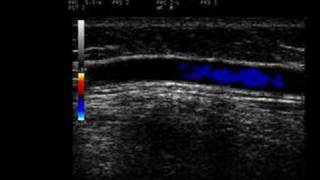 Phlebology Biosound Esaote MyLab 25 Proximal GSV with Reflux [upl. by Sharline]