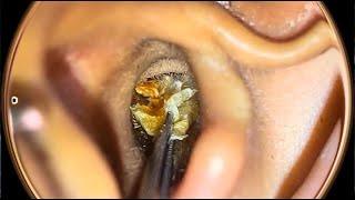 ASMR Ear wax removal satisfying asmr [upl. by Letty]