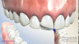 Diamond Strip for Interporximal Reduction  Orthodontic Treatment [upl. by Naenaj]