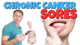 Dealing with Chronic Canker Sores [upl. by Imar]