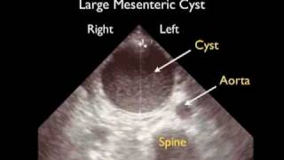 How To Aorta Ultrasound  Aneurysms Case Study Video [upl. by Timus678]