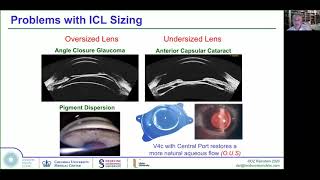 Implantable Collamer Lens ICL  from basics to advanced sizing methodology [upl. by Arlo]