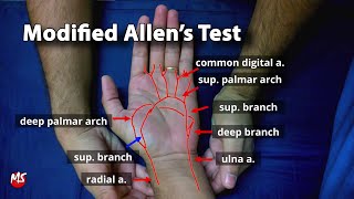 Modified Allens test [upl. by Ire]