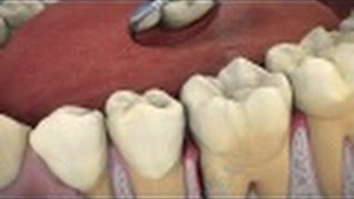 The Role of ARESTIN® in Periodontal Treatment [upl. by Amilb]