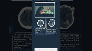 contusion vs subduralhematoma [upl. by Anirok]