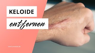 Wie lassen sich Keloide entfernen [upl. by Nyleimaj581]