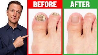 The REAL Cause of Toenail Fungus is [upl. by Geof]