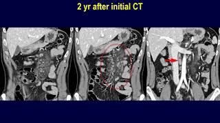 Mesenteric follicular lymphoma vs mesenteric panniculitis [upl. by Edgerton]