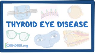 Thyroid Eye Disease causes symptoms diagnosis treatment pathology [upl. by Kerekes]