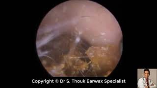 Top Biggest Ear Wax Removal 95  Ear wax Extraction  Dr S Thouk Earwax Specialist [upl. by Airdnek]