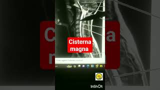 Anatomia Cisterna Magna [upl. by Delora]