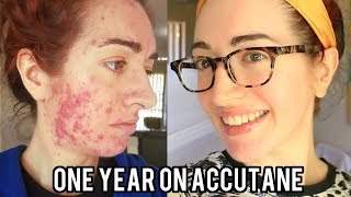 ACCUTANE Before And After Severe Acne With Pictures My Experience  Jess Bunty [upl. by Reywas845]