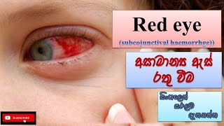 Red eye අසාමාන්‍ය ඇස් රතු වීම් how it happens causes symptoms treatment how to prevent [upl. by Ocir]