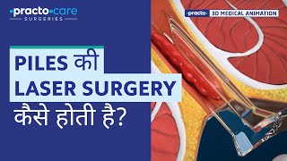 Piles Laser Surgery  Procedure Animation  Best Treatment for Piles  Practo Care Surgeries [upl. by Yrnehnhoj]