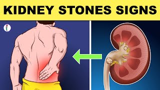 Kidney Stones Symptoms  All You Need to Know [upl. by Raveaux998]