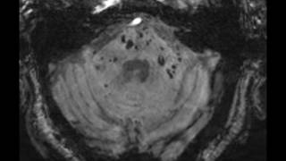 Multiple Cavernoma Syndrome [upl. by Airemat]