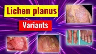 Clinical variants of lichen planus [upl. by Harihs]