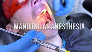 Techniques for Mandibular Anaesthesia  VaziraniAkinosi Mandibular Block Technique dentist dental [upl. by Anivol25]