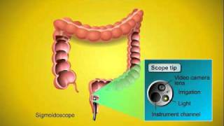 Colorectal Cancer Screening [upl. by Anitnamaid]