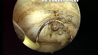 Hysteroscopic Myoma Resection For Deep Submucous and Intramural Myomas [upl. by Ietta937]