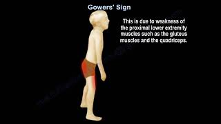 Gowers Sign [upl. by Jabe538]