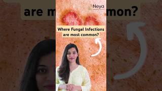 Causes of fungal skin infections  Fungal infection on skin  Skin Doctor in Hyderabad [upl. by Rebel]