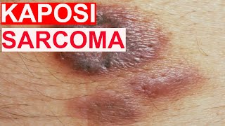 Kaposi Sarcoma [upl. by Gereron446]