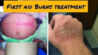 Top Tips for Burns by Dr AmaraBurn Treatment at Home 2024Quench Cream UsesSide effectsDr Health [upl. by Gretel812]