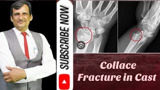 Collace Fracture in cast sheetalchhaya bestlab ajaykaushik bloodtestexpart scdhomecare delhi [upl. by Enylecoj]