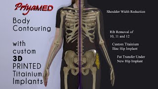 PriyaMED presents A New CURVY you  ShouldersRibsHipsFat Transfer [upl. by Alyakim]