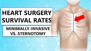 Surgeon QampA “Survival Rates of MinimallyInvasive Versus Sternotomy for Heart Valve Surgery” [upl. by Franklyn949]