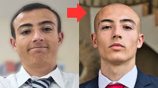 BALDING 17 to 18 Years Old [upl. by Ruzich332]