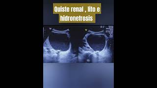 QUISTE RENAL LITO E HIDRONEFROSIS DOLOR RENAL CRÓNICO [upl. by Rik]