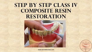 STEP BY STEP  Class IV dental restoration with composite [upl. by Annayat]