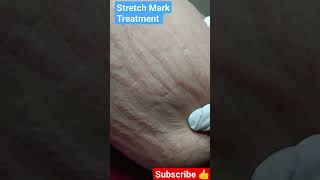 Stretch Mark Treatment lasertreatment viral shortsvideo [upl. by Otcefrep]